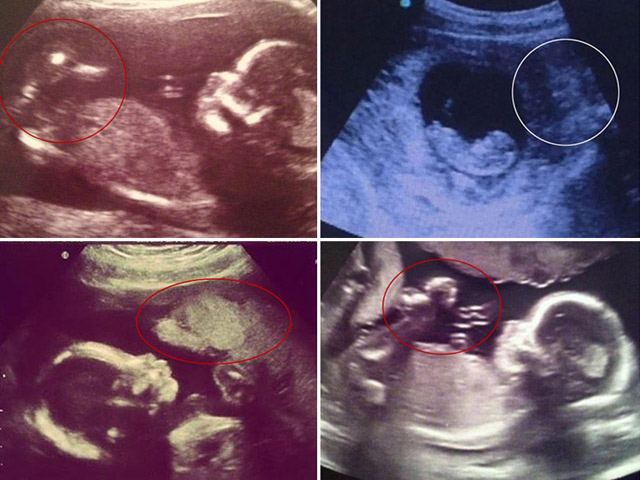 Những hình ảnh siêu âm thai khiến người xem lạnh gáy