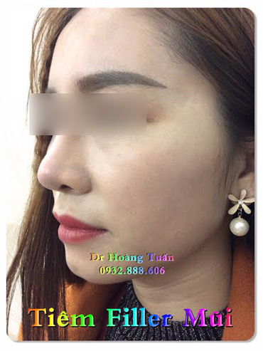 Phái đẹp Hà thành #039;đổ xô#039; đi làm đẹp không dao kéo dịp cuối năm - 4
