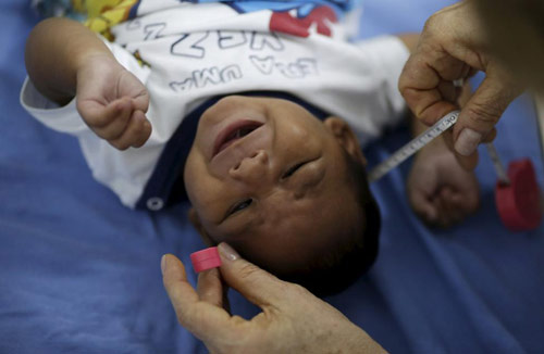 Virus Zika gây #039;teo não#039; dưới góc nhìn của bác sĩ chuyên khoa - 1