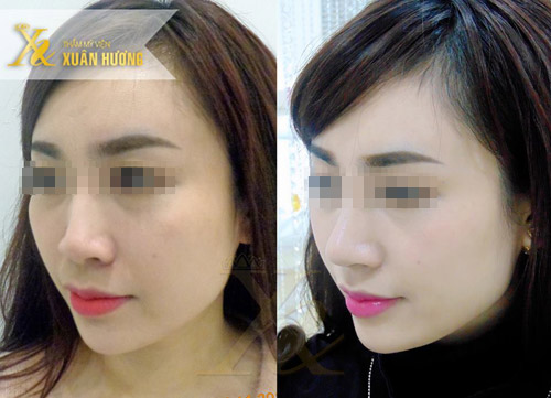 Mũi cao có phải là mũi đẹp? - 3