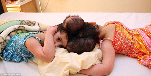 Phẫu thuật tách rời thành công cặp song sinh dính liền đầu - 1