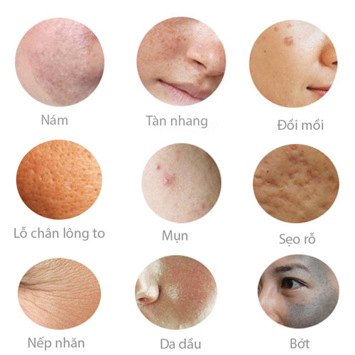 “Thổi bay” nám, tàn nhang: Không khó như bạn nghĩ! - 2