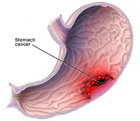 Phát hiện ra enzim phòng chống bệnh ung thư dạ dày - 1