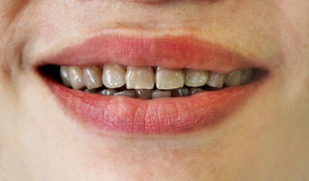 Sứ Creation - “cứu tinh” cho răng nhiễm màu Tetracyline - 1