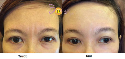 Đánh tan bọng mỡ mắt trong 60 phút không phẫu thuật - 2