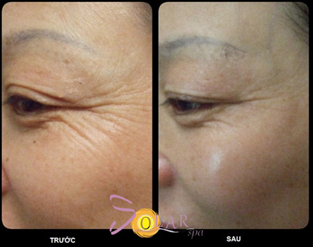 Đánh tan bọng mỡ mắt trong 60 phút không phẫu thuật - 5