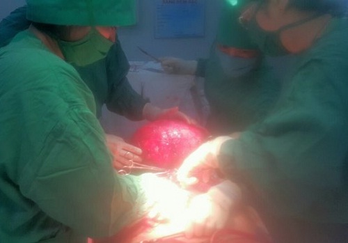 Một phụ nữ bị u xơ tử cung nặng hơn 12 kg - 1