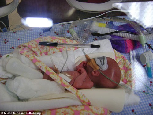 Sinh ra chỉ bằng cây bút bi, bé gái vẫn sống khỏe mạnh - 2