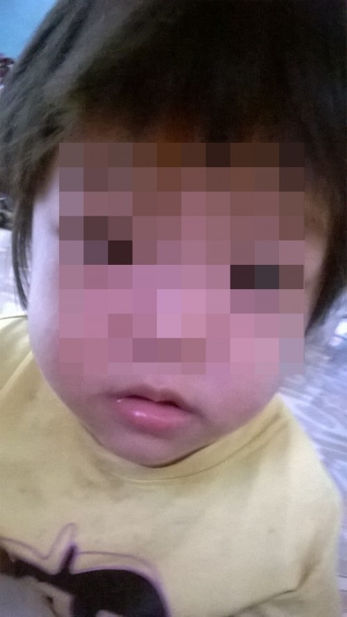 Lần đầu tiên cứu sống bé gái suy tim hiếm gặp - 1