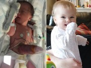 Bà bầu - Sinh ra với "ruột để ngoài da" nhưng em bé này đã lớn lên đáng yêu không ngờ