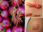 Làm đẹp - Sẹo thâm như hoa sim cũng khỏi nhờ công thức dễ ợt từ hành tím