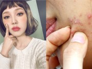 Làm đẹp - 99% chị em mắc phải 5 thói quen này khiến mụn mọc như nở hoa trên mặt