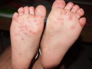 Sức khỏe - Bé 19 tháng tuổi tử vong do tay chân miệng, bố mẹ cần lưu ý gì?