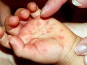 Sức khỏe - Dịch tay chân miệng lan rộng, dấu hiệu nào nhận biết bệnh sớm nhất?