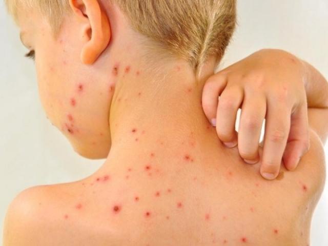 Bố mẹ nhầm thủy đậu với bệnh sởi, nhiều trẻ nguy kịch
