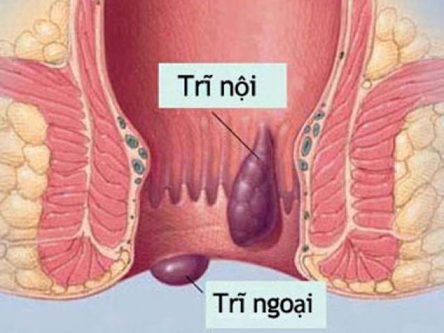 Người bị bệnh trĩ nên kiêng ăn gì?