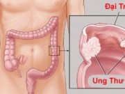 Sức khỏe - Tuyệt đối tránh xa 6 thực phẩm này nếu bạn không muốn bị ung thư đại tràng