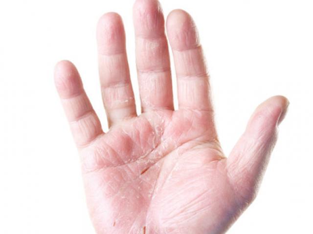 7 sự thật đáng ngạc nhiên về bệnh vảy nến
