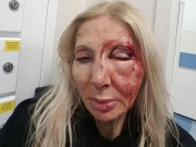 Phụ nữ 60 tuổi bị đánh trọng thương vì từ chối nói chuyện với người đàn ông lạ