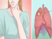 Sức khỏe - Phụ nữ không nên bỏ qua những dấu hiệu ung thư phổi này