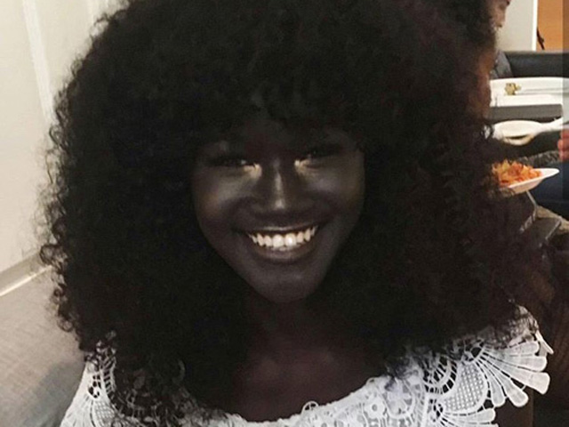 Làn da không bình thường nhưng những cô gái này vẫn gây sốt làng mốt