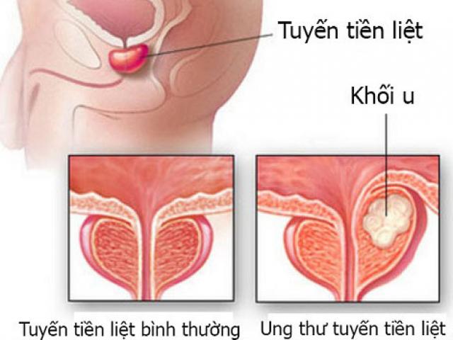 Dấu hiệu ung thư tiền liệt tuyến là gì?
