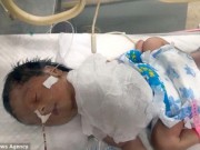 Tin tức - Mắc bệnh lạ, em bé sơ sinh có tim nằm ngoài lồng ngực