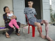 Tin tức - Gia cảnh đáng thương của người bố trẻ cụt hai tay một mình nuôi con thơ khát sữa
