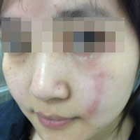 Viêm da tiếp xúc vào mùa sớm