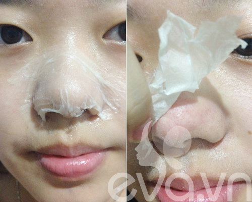Nhật ký Hana: Lột mụn đầu đen ở mũi - 5