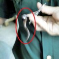 Tin tức - Hai con vắt dài 7cm ngọ nguậy trong mũi