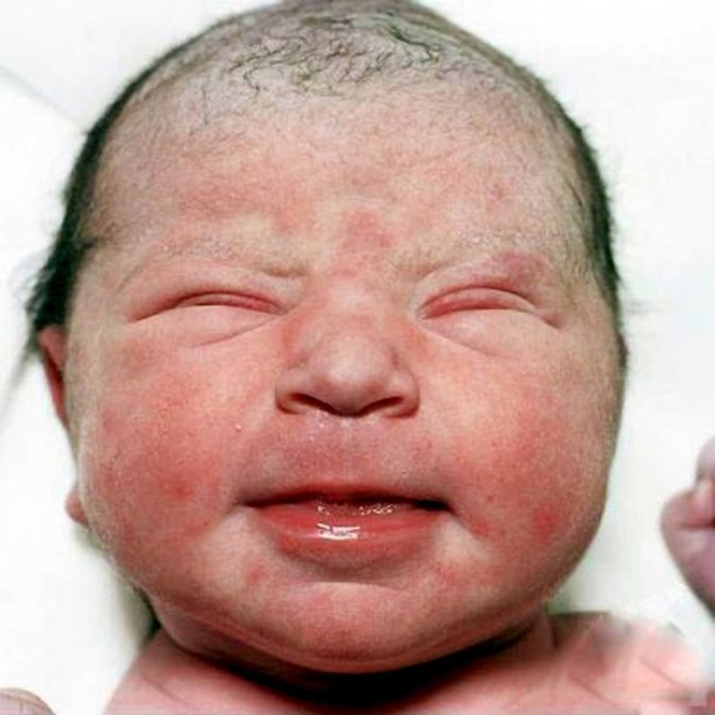 Mới chào đời, phủ khắp mặt và toàn thân bé sẽ có một lớp phấn hoặc lông tơ mỏng.
