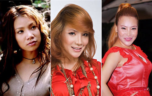 Sao và biến chứng lạm dụng botox - 5