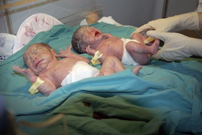 Các bé được đưa vào phòng hậu phẫu để tiến hành xạ trị cơ bản.
