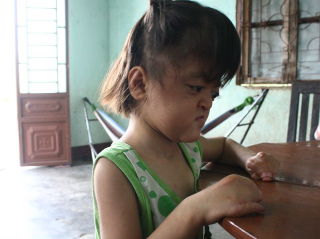 Bé gái 4 tuổi mang khuôn mặt bà lão - 1