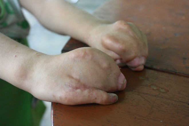 Bé gái 4 tuổi mang khuôn mặt bà lão - 2