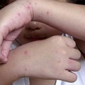 Tin tức - Thủ tướng yêu cầu dập dịch tay chân miệng, sốt xuất huyết