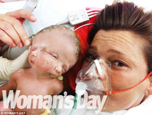 Bé gái có 2 khuôn mặt, 2 bộ não chào đời ở Úc - 1