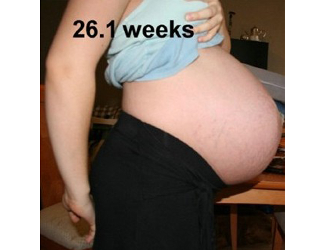 Bước sang tuần 26, da bụng mẹ bắt đầu có dấu hiệu bị rạn. Thời điểm mẹ bị rạn da là hơi sớm so với những người mang bầu đơn thai.
