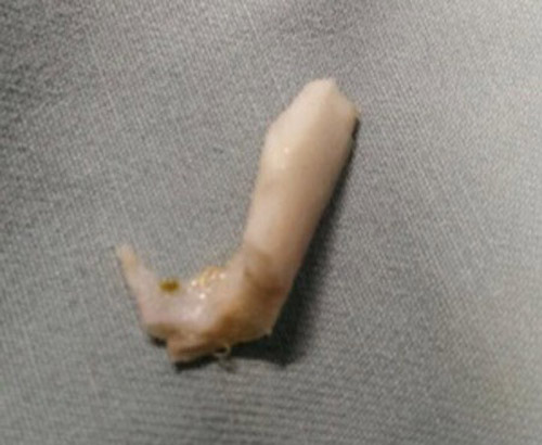 Lo lắng: trẻ hóc dị vật nguy hiểm đầu hè - 1