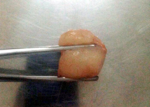 Lo lắng: trẻ hóc dị vật nguy hiểm đầu hè - 2