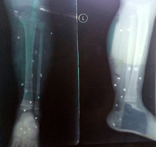 Côn đồ nổ súng, bé 4 tuổi quot;dínhquot; 15 viên đạn - 1