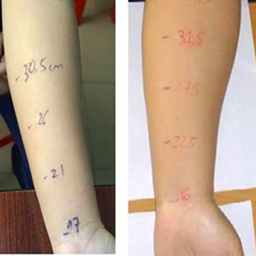 Ghép hạch bạch huyết, niềm vui của phụ nữ ung thư vú - 1