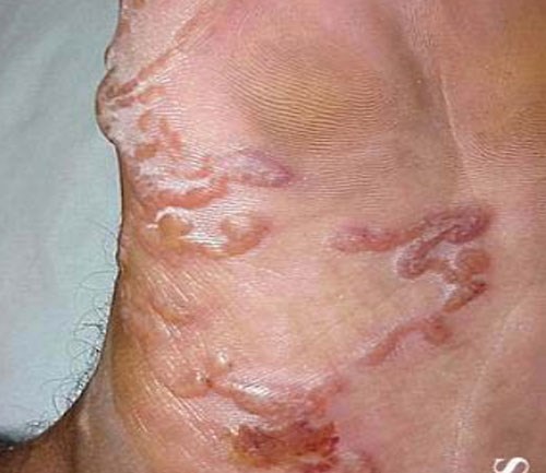 Ăn gỏi, rau sống: Ngứa khắp người do ký sinh trùng bò dưới da - 1