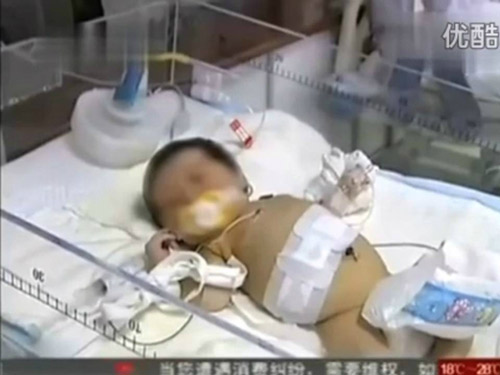 Kinh ngạc với bé sơ sinh mang thêm thai đôi trong bụng - 1