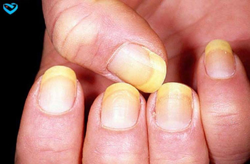 Đoán tình hình sức khỏe của bạn qua móng tay - 1