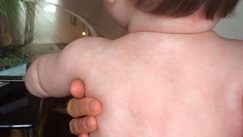 Canada: Cha gửi thư cho #039;hội phản đối tiêm chủng#039; khi con bị sởi - 1