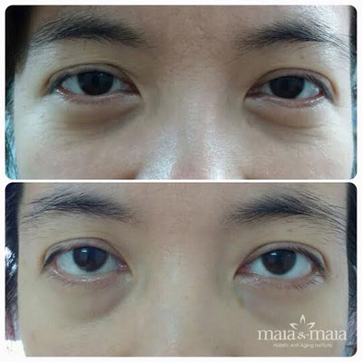 60 phút tìm lại “15 tuổi xuân” với trẻ hóa ultherapy - 2