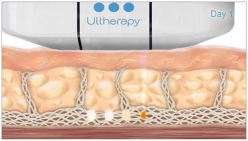 60 phút tìm lại “15 tuổi xuân” với trẻ hóa ultherapy - 3