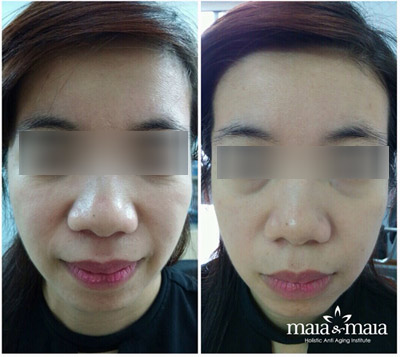 60 phút tìm lại “15 tuổi xuân” với trẻ hóa ultherapy - 4